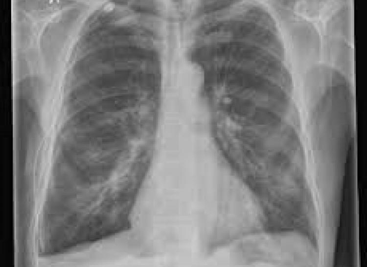 malignant-pleural-effusion-icd-10-sequencing